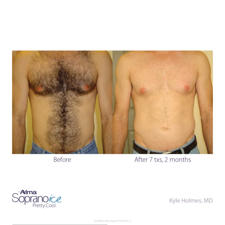 Men's body laser hair removal