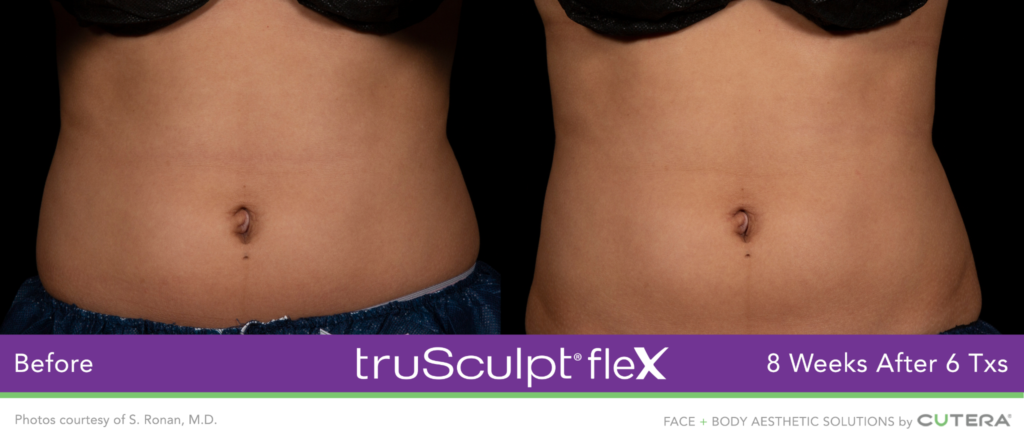 truSculpt Flex